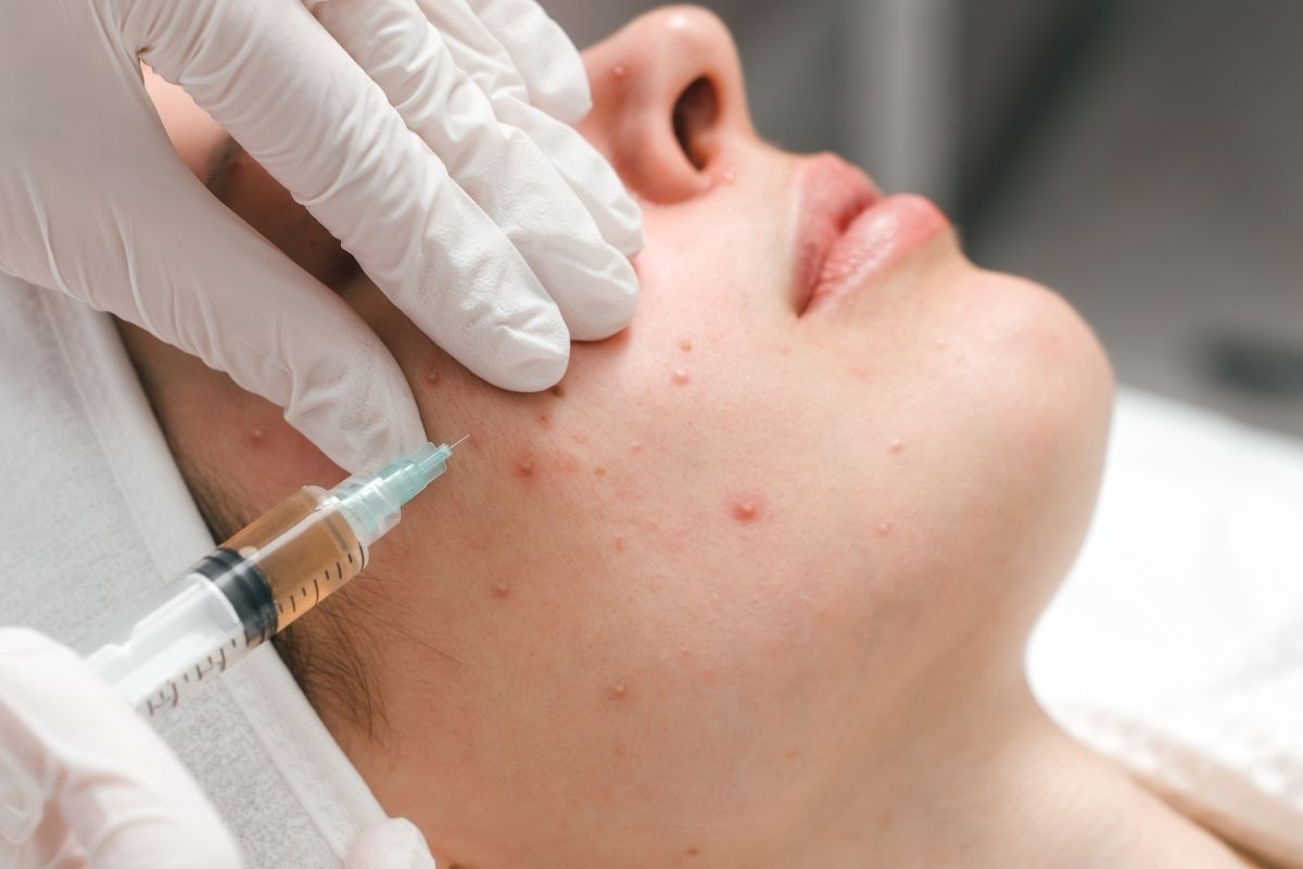 A dermatologist performing a procedure to reduce acne scars on a client’s face.