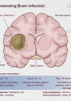 Illustration showing a coronal brain slice with a brain abscess or infection.
