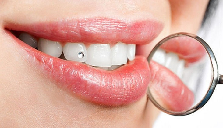 Powerbleaching&Diamantsteinchen