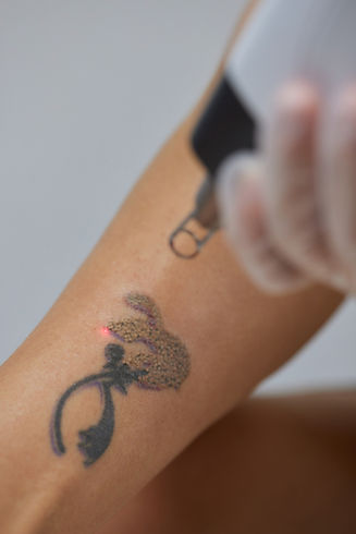 young-woman-undergoing-laser-tattoo-removal-procedure-salon-closeup.jpg