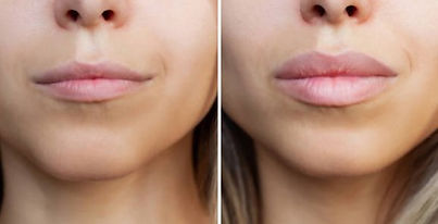 lipfiller.jpg