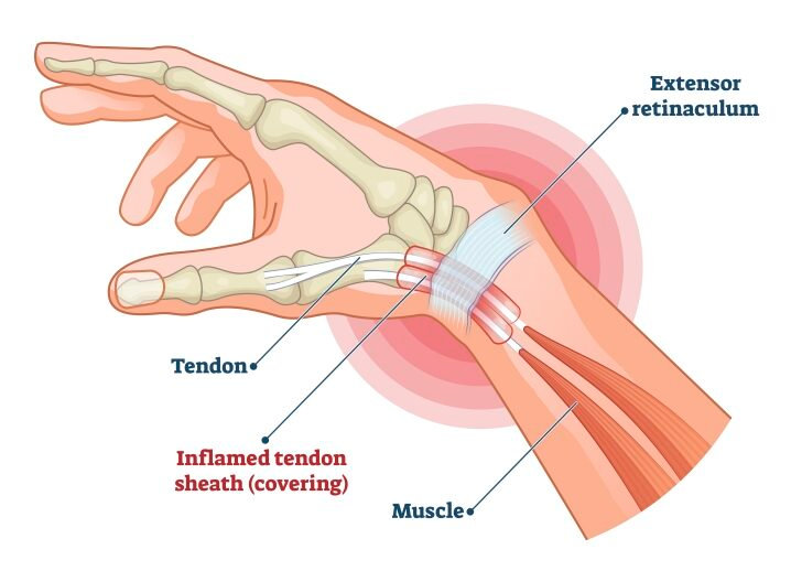 腱鞘炎 拇指腱鞘炎(De Quervain's Tenosynovitis) | Supreme