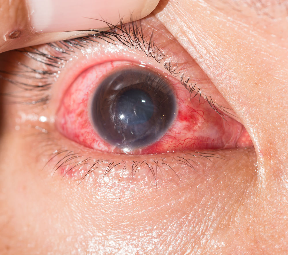 Pink Eye Treatment: It's Not as Difficult as You Think