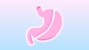A drawn image of a stomach that has had gastric sleeve surgery