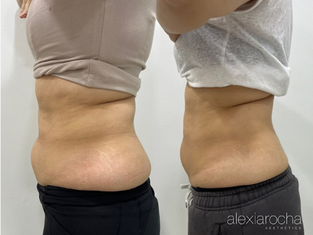 Skin Tightening After Weight Loss