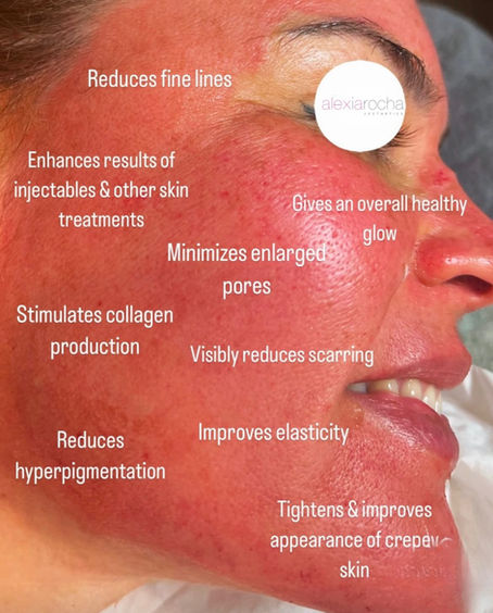 10 Benefits of Skin Needling