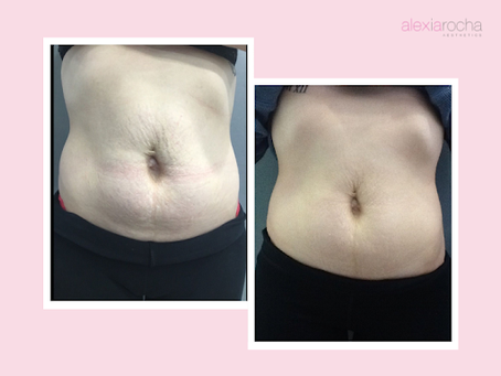skin needling for stretch marks