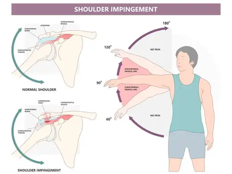 Effective Ways to Manage Shoulder Impingement: Expert Physiotherapy Tips