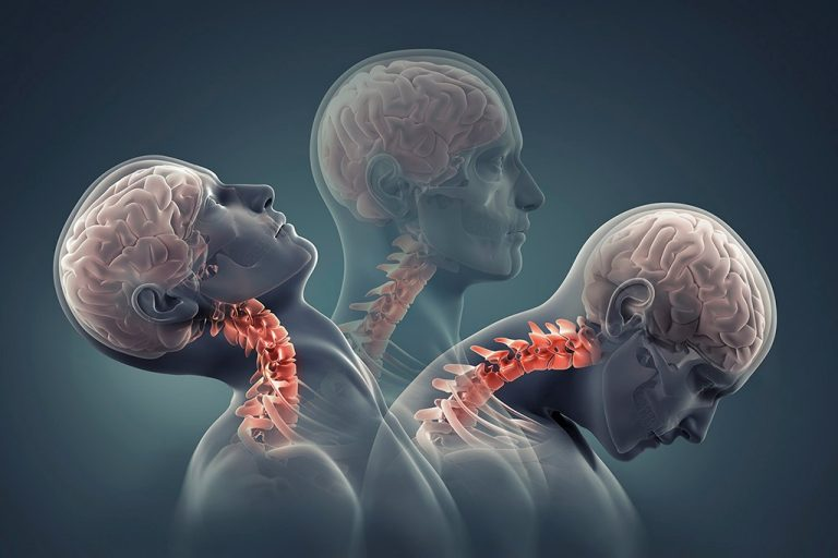 Why Neck Health Matters After a Concussion