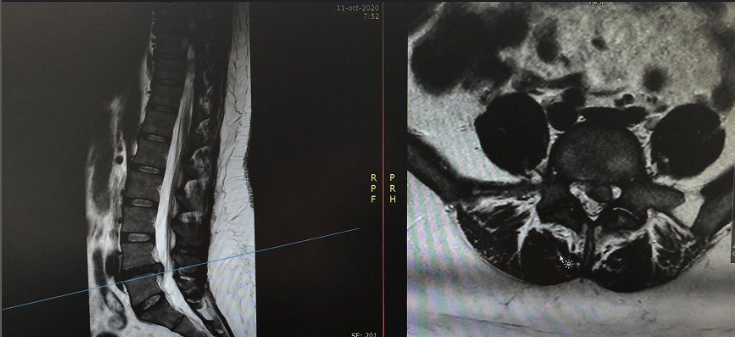 Tratamiento de hernia discal en Valencia