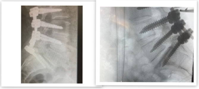 Reintervención de paciente