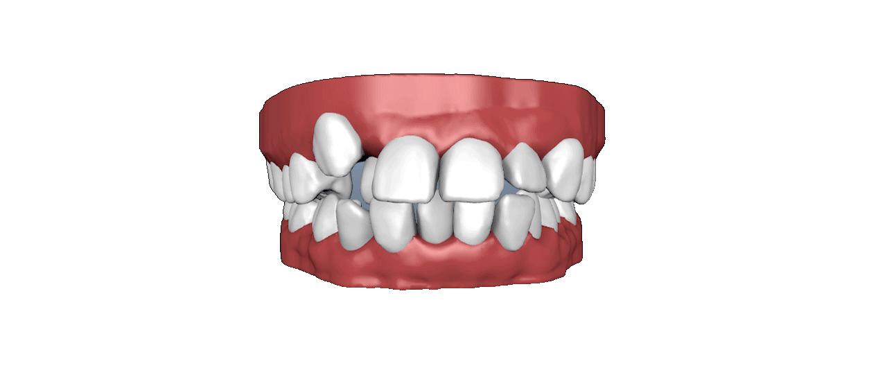 teeth_simulation.gif