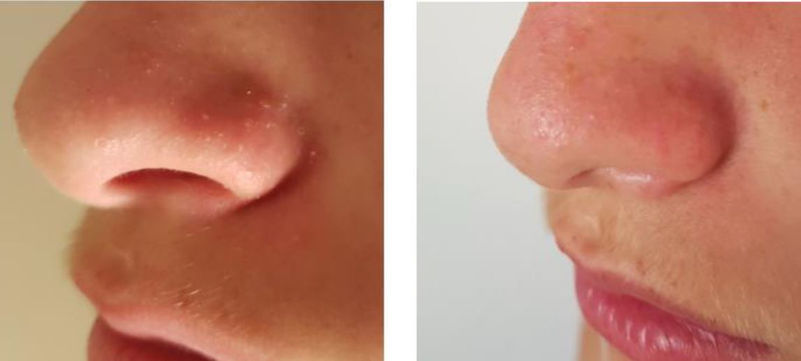 seance de photobiomodulation pour gommer rides