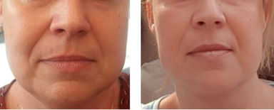 seance de photobiomodulation pour gommer rides