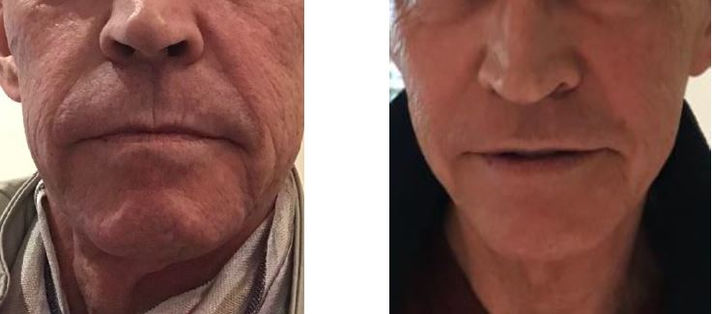 seance de photobiomodulation pour gommer ridules