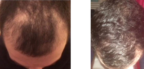 seance de photobiomodulation pour stopper la chute des cheveux