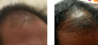 seance de photobiomodulation pour stopper la chute des cheveux