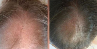 seance de photobiomodulation pour stopper la chute des cheveux