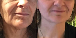 seance de photobiomodulation pour gommer rides