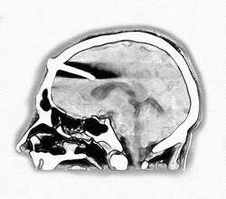 An Incompetent Suicide