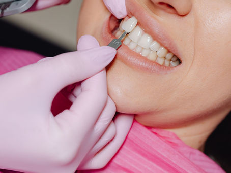 Dental Veneers: A Guide to a Natural-Looking Smile
