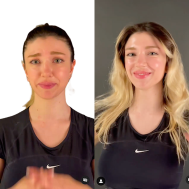 Chin Filler Before and After Photo 2