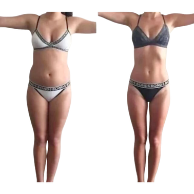 Liposuction Before and After Photo #1