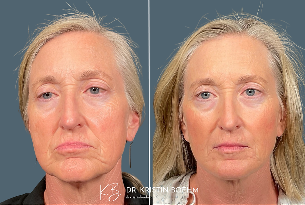 Dermal Filler - Lower Face Filler - Facial Rejuvenation - Before & After - DrKristinBoehm.com
