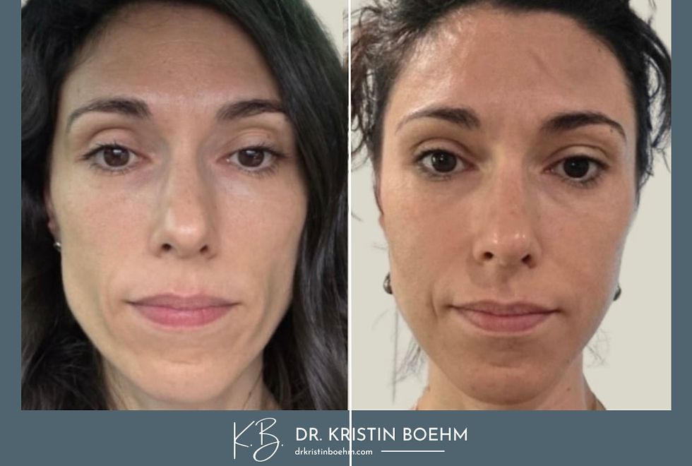 Biostimulator - Sculptra - Before & After - DrKristinBoehm.com