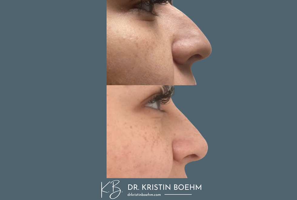 Non-Surgical Rhinoplasty - Dermal Filler - Before & After - Drkristinboehm.com