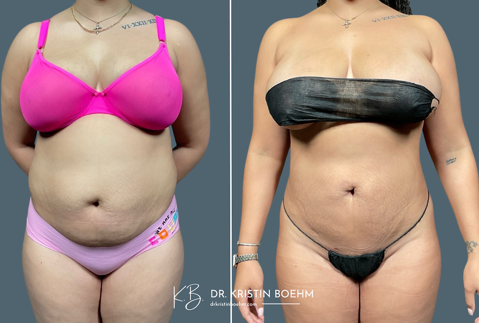 Liposuction - Abdominal Liposuction - BEfore & After Plastic Surgery - Drkristinboehm.com