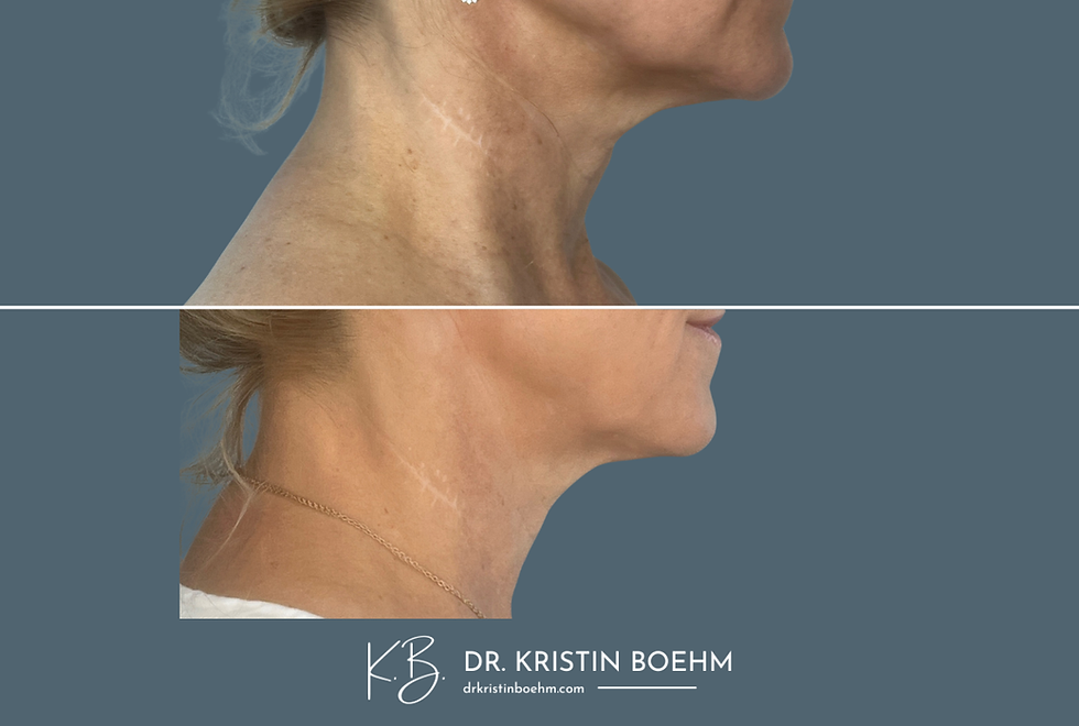 Biostimulator - Neck - Neck Rejuvenation - Before & After - DrKristinBoehm.com
