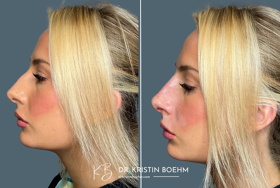 DrKristinBoehm.com Before & After Plastic Surgery (2)