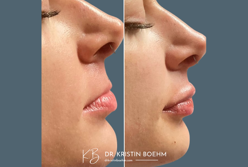 DrKristinBoehm.com Before & After Plastic Surgery (2)