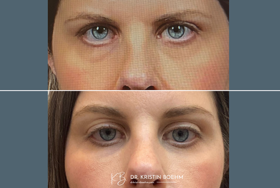 Dermal Filler - Under Eye Filler - Before & After - Drkristinboehm.com