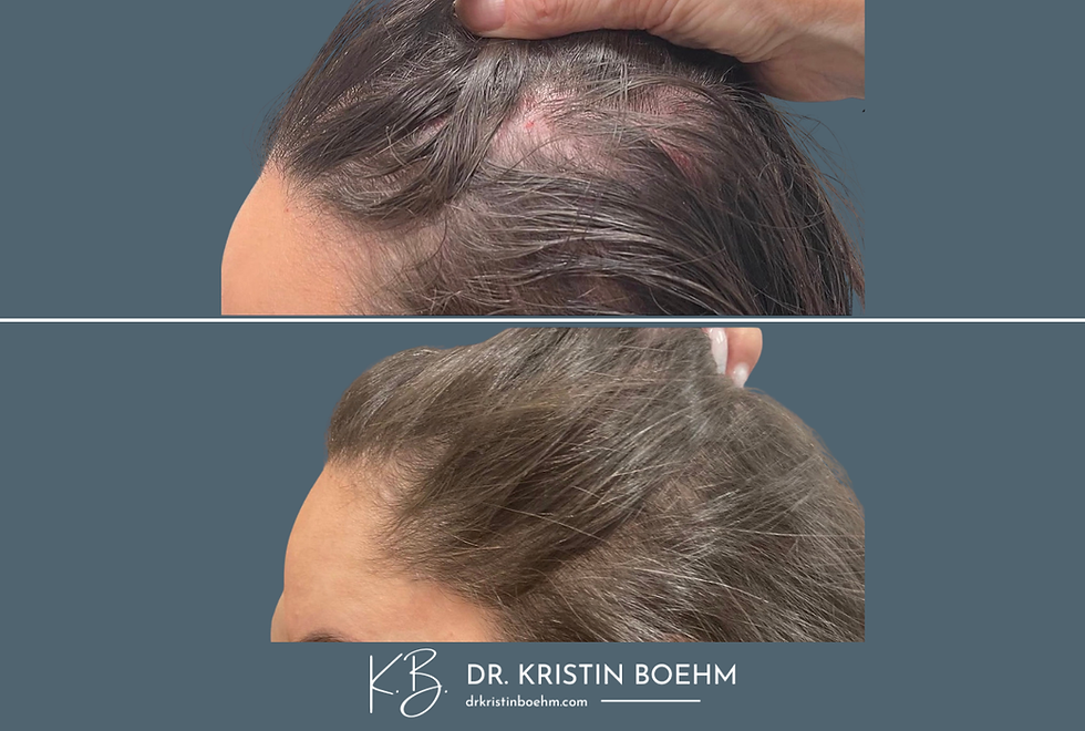 Platelet Derived Growth Factor - PDGF - Hair Stimulation - Before & After - DrKristinBoehm.com