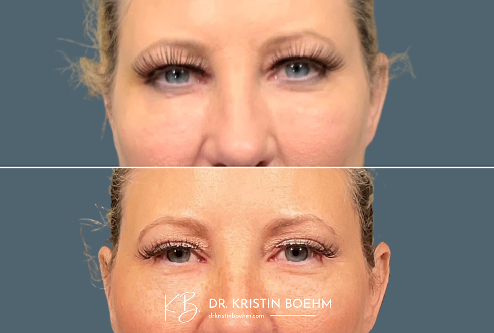 Upper Lid Blepharoplasty - Before & After Plastic Surgery - DrKristinBoehm.com