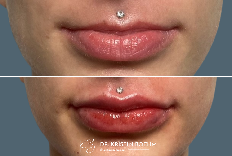 Dermal Filler - Lip Filler - Before & After - DrKristinBoehm.com