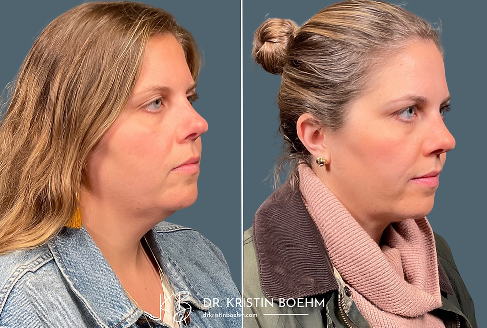 DrKristinBoehm.com Before & After Plastic Surgery