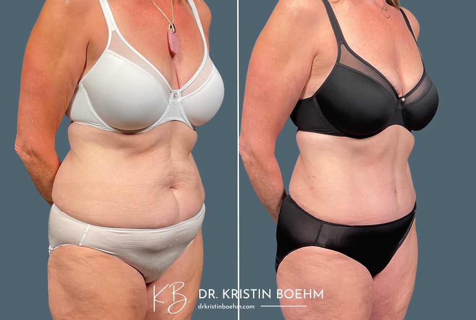 DrKristinBoehm.com Before & After Plastic Surgery (4)