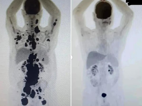 Estudo aponta redução significativa do linfoma em 90% dos pacientes tratados com terapia CAR-T desenvolvida pela USP