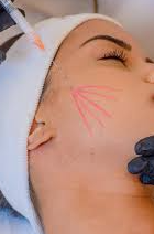 Anvisa impede uso e venda de bioestimulador de colágeno e implante dentário