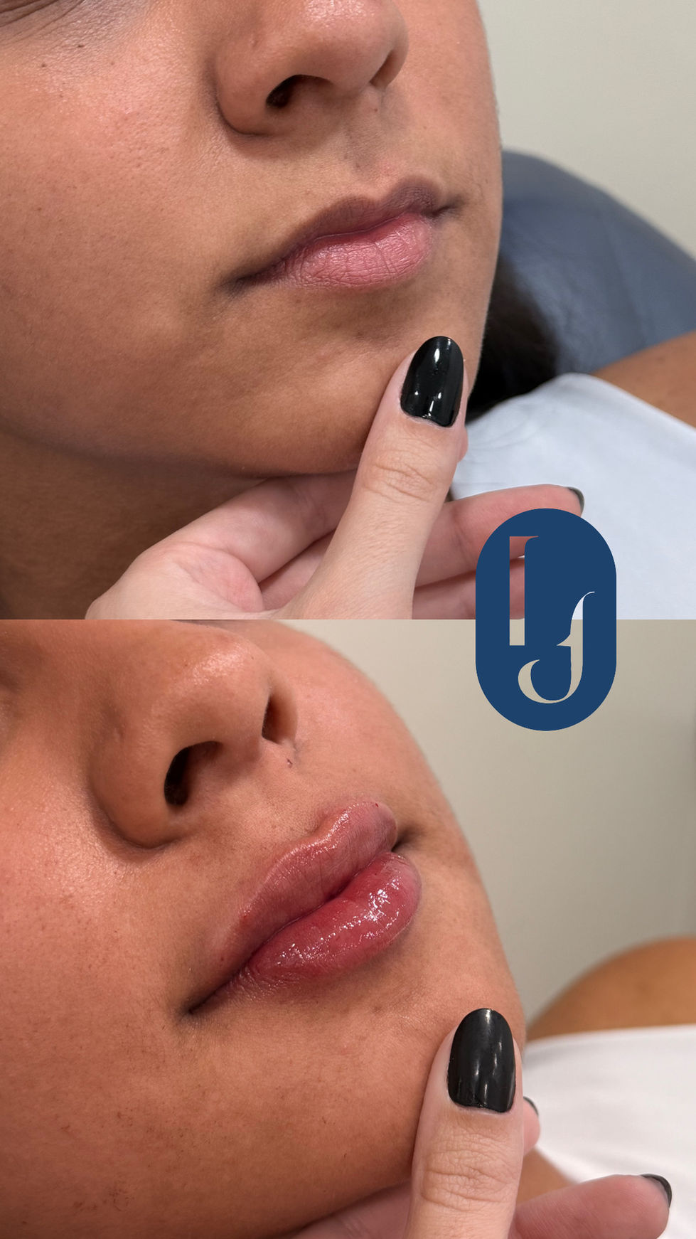 Preenchimento labial