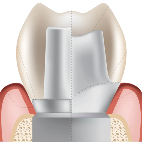 Why Custom Abutments Outperform Stock Every Time