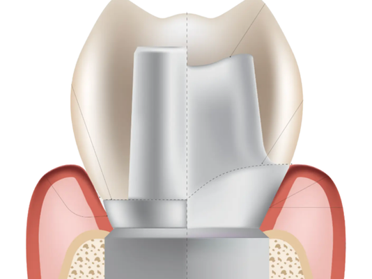 Why Custom Abutments Outperform Stock Every Time