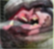 exérese-de-tumores1.png