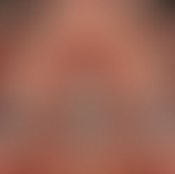 เจาะลึกเครื่องมือ MARPE / MSE จบปัญหาเพดานแคบ ฟันซ้อน นอนกรน! ไม่ต้องพึ่งมีดหมอ