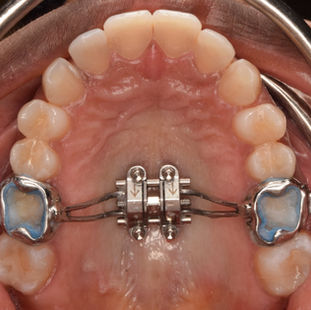 เจาะลึกเครื่องมือ MARPE / MSE จบปัญหาเพดานแคบ ฟันซ้อน นอนกรน! ไม่ต้องพึ่งมีดหมอ