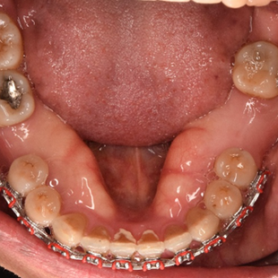 What Are These Bone Lumps in Your Mouth?
