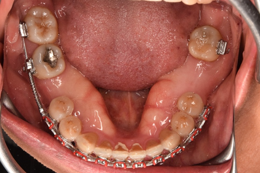 ปุ่มกระดูกปริศนาในปาก: Torus และ Exostosis คืออะไร? จำเป็นต้องเอาออกไหม?